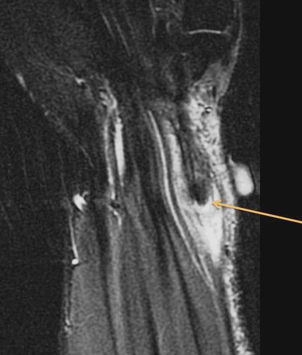 Figure 6 for case Flexor carpi radialis tendon laceration ( RID2388 )